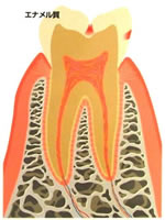 虫歯段階（C1)
