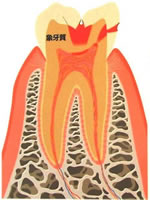 虫歯段階（C2）