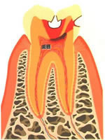 虫歯段階（C3）