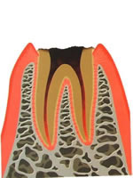 虫歯段階（C4）